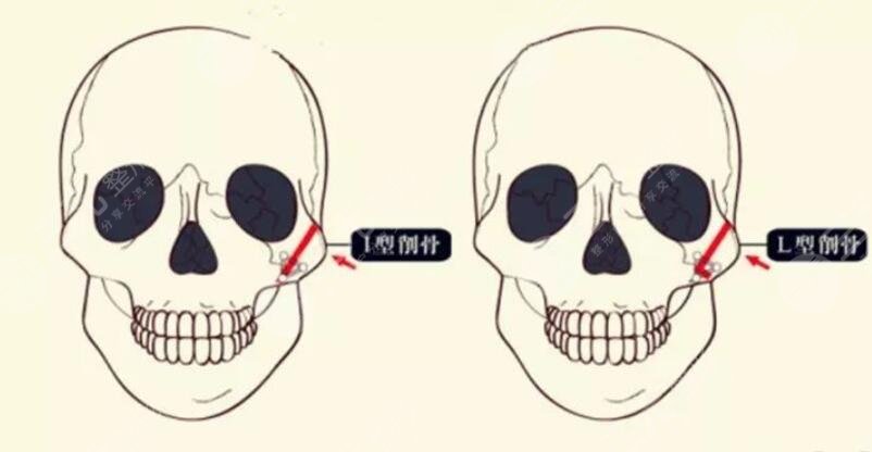 颧骨整形价格