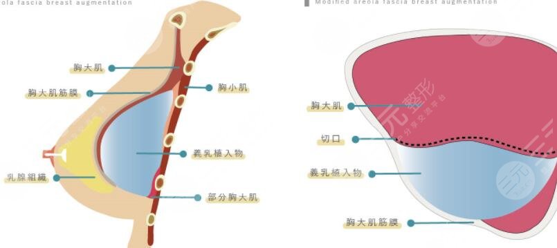 假体隆胸手术的原理