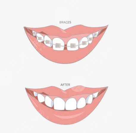 牙齿矫正项目科普