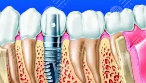 牙齿种植项目科普