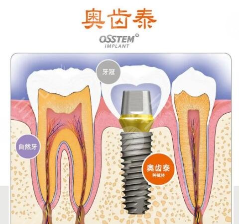 韩国OSstem奥齿泰种植系统