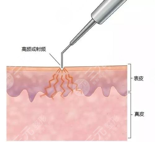 中山大学附属第一医院美容科祛痣案例分享|网友恢复心得