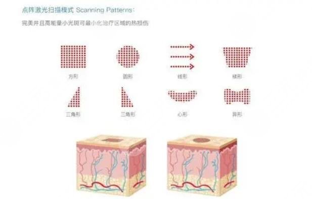 广州南方医院点阵激光案例