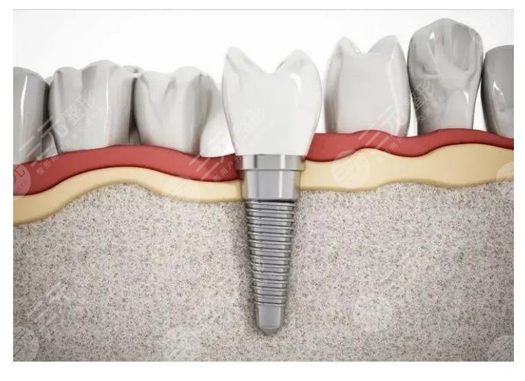 种植牙的优点