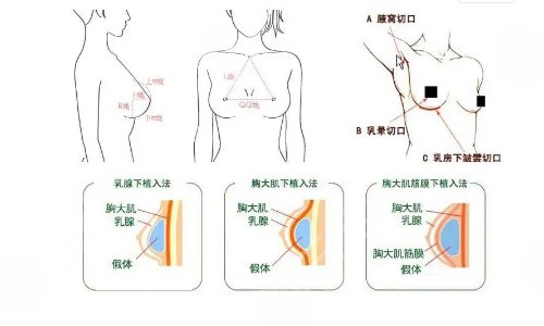 3D隆胸手术好不好?