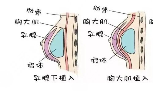 假体隆胸3d演示过程图片