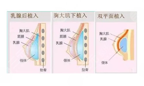 假体隆胸3d演示过程图片