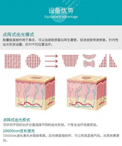 点阵激光