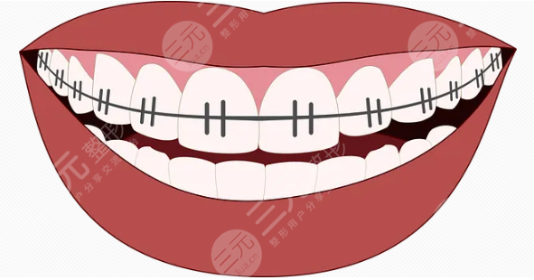 矫正牙齿的危害盘点！附常用方式+注意事项盘点！正畸攻略~