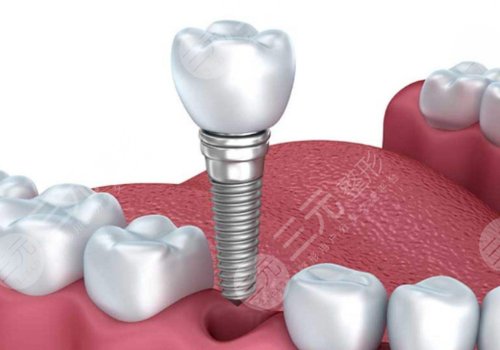 种植牙有什么风险和后遗症？多少钱？附价格表更新表