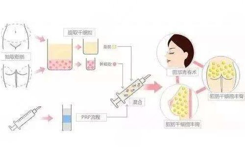 自体脂肪填充太阳凹陷能维持多久？多少钱？疼吗？附价格表+注意事项