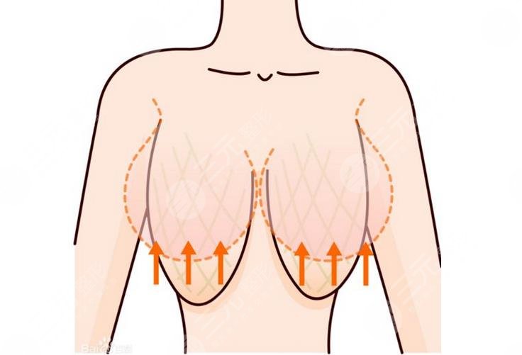 什么是乳房提升棒棒糖