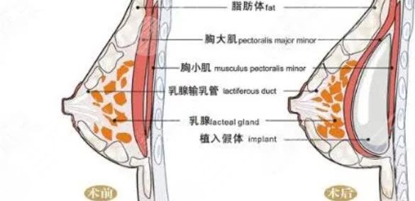 韩国蓓拉假体价格是多少？贵不贵？隆胸效果手感怎么样？