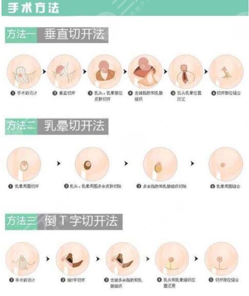 怎么让胸变大 17岁图片