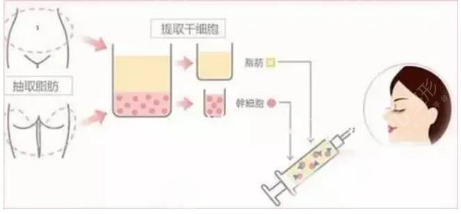 脂肪填充手术受欢迎吗?