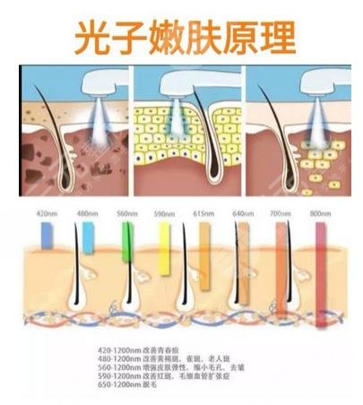 光子嫩肤