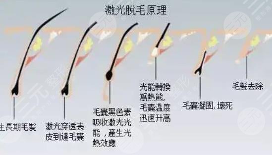 腋下激光脱毛后需要注意什么?