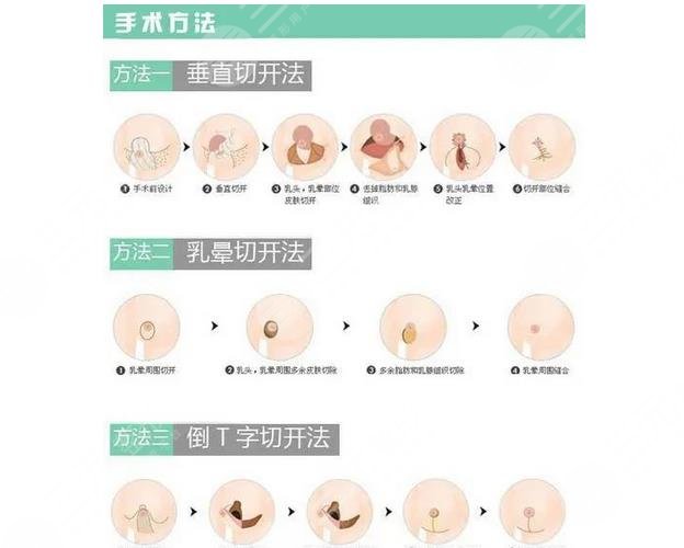 棒棒糖缩胸手术什么意思?