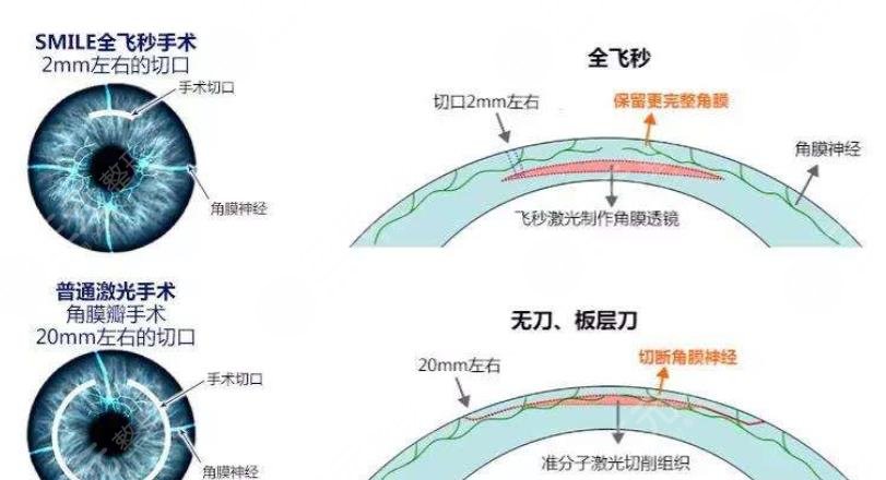 全飞秒近视矫正手术之后可以蹦极吗?