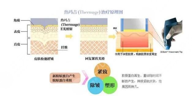 热玛吉是否真的会让面部紧致？