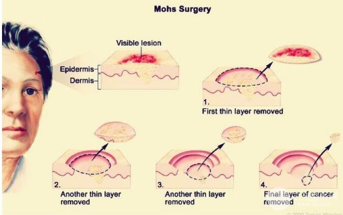 图5 Mohs手术的操作流程示意图