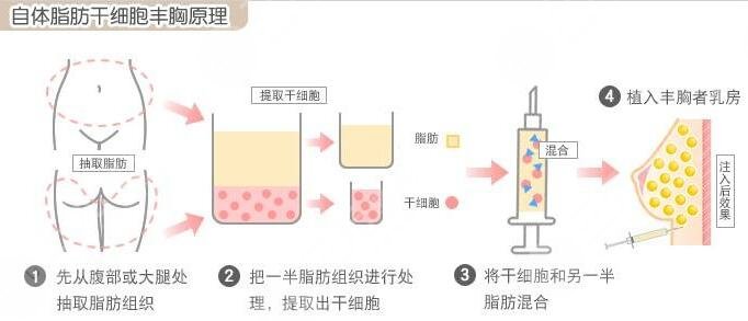 北京爱多邦医院面部脂肪填充案例分享