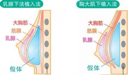 假体隆胸手术的原理