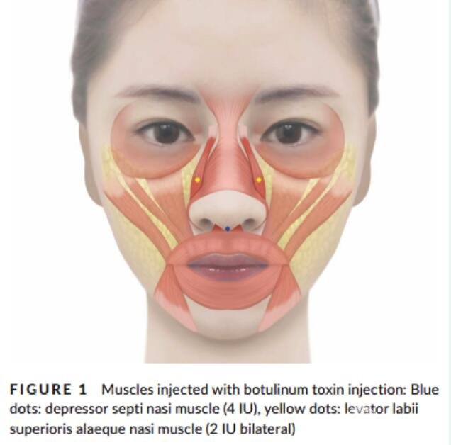 图2 BoNT-A注射降鼻中隔肌及双侧提上唇鼻翼肌改善鼻部对称性示意图(蓝点为降鼻中隔肌，黄点为提上唇鼻翼肌)