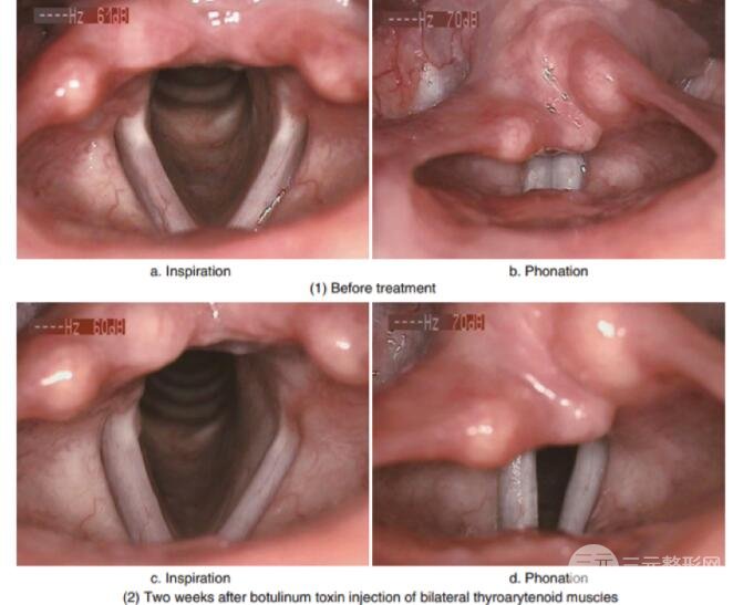 图1 痉挛性发声障碍治疗前及BoNT-A治疗2周后示意图