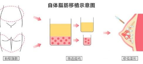 自体脂肪隆胸的缺点有哪些?