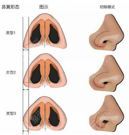 合肥甘泉涌肋骨鼻前