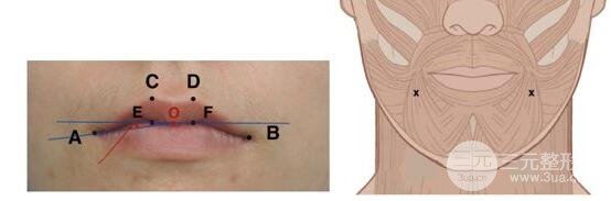 图6 左图的红色角即为口角下垂的角度，右图为注射点位示意图