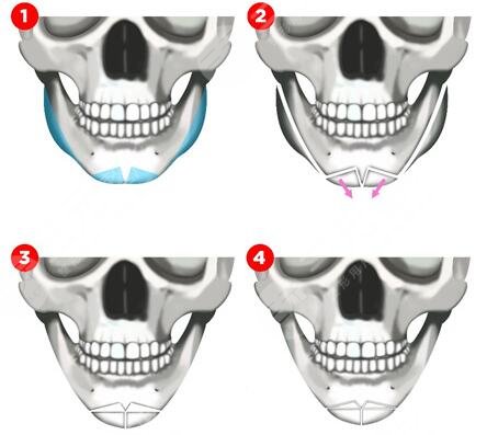 下颌角整形术全过程详细揭秘，下颌角手术改脸型果理想吗？