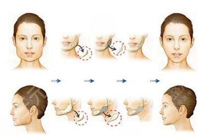下颌角整形术全过程详细揭秘