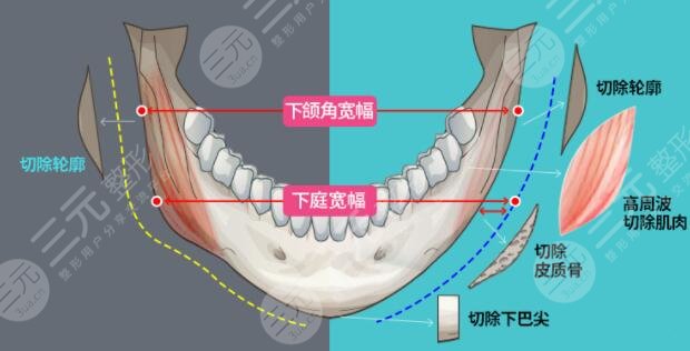 下颌角切除手术大概的费用要多少呢