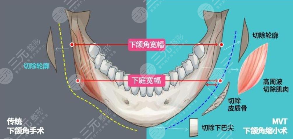 下颌角截骨