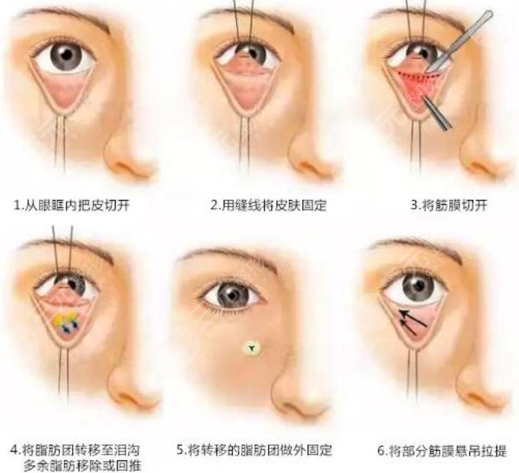 去眼袋手术的原理