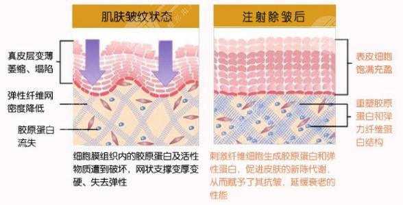 怎样快速去掉抬头纹：电波拉皮