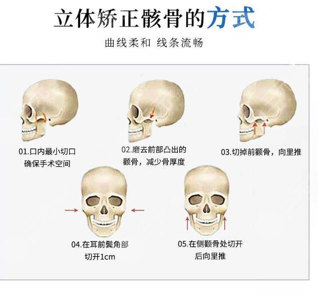 颧骨整形术