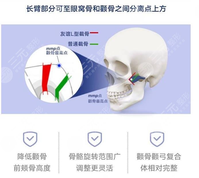 颧骨整形术原理