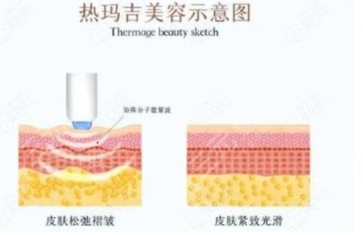 热玛吉除皱抗衰手术