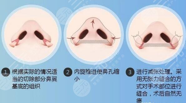 周亚超隆鼻术后果图