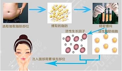 冯斌脂肪填充全脸经历