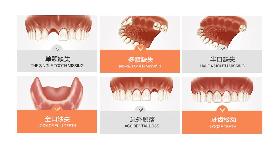 上海美奥口腔门诊部科普种植牙手术知识