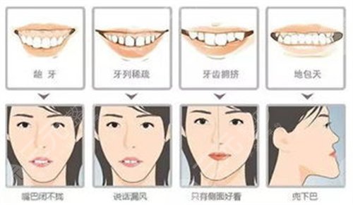 深圳北大医院牙齿矫正正畸案例：术后