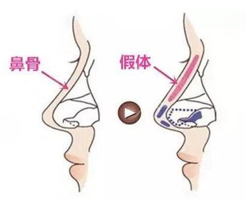 乔雅登玻尿酸来自正规渠道价格是多少