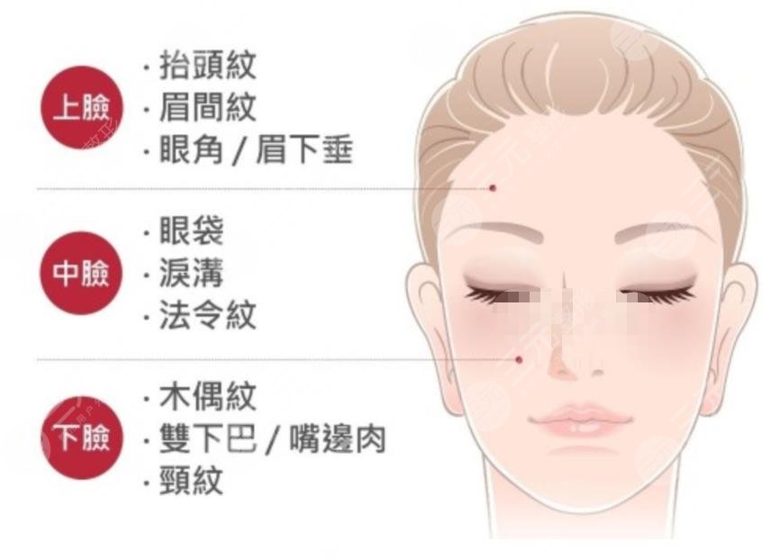 拉皮相关知识科普盘点