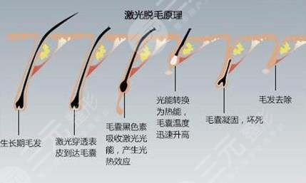 络腮胡子激光脱毛去除的过程