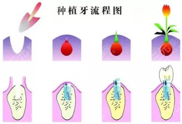 种植牙技术果如何