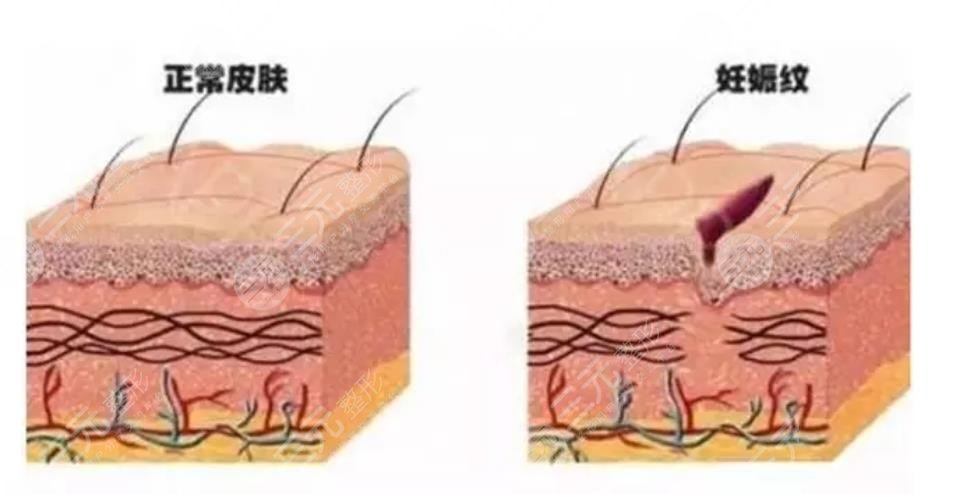 激光去除妊娠纹的原理